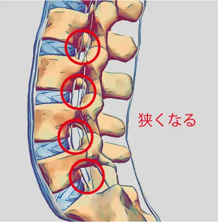 狭窄症画像