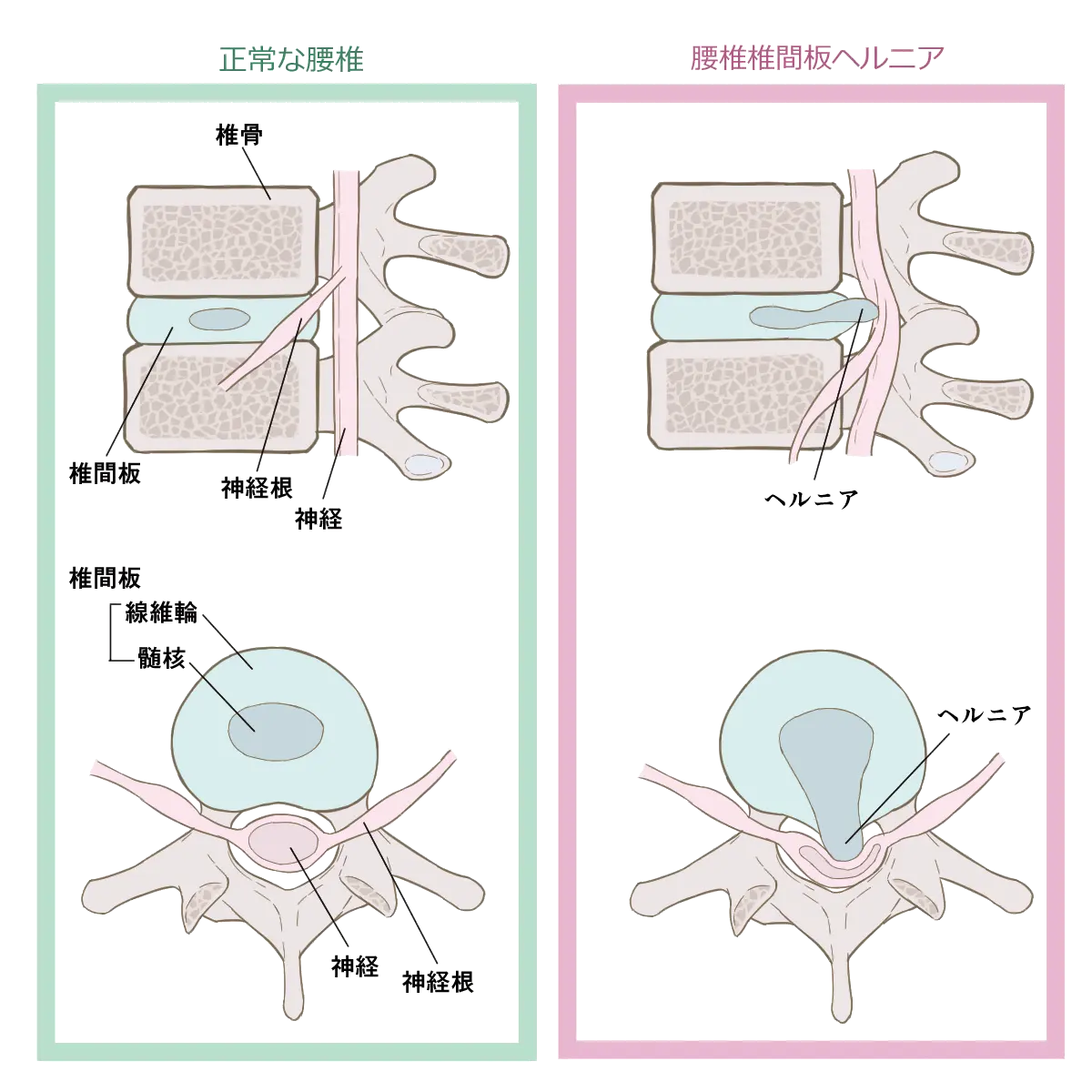 ヘルニア画像