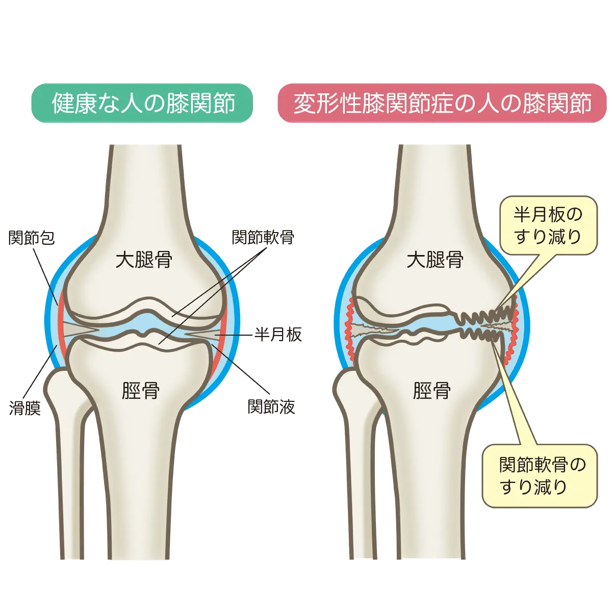 変形性膝関節症画像