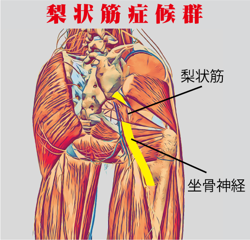 坐骨神経痛画像