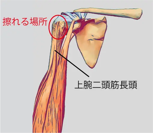 長頭腱炎画像