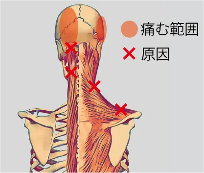 頭痛画像